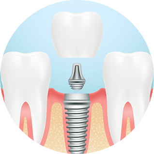 Dental Implants