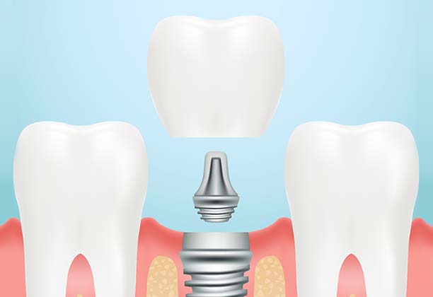 Dental Implants