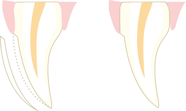 ラミネートべニア(貼り物)