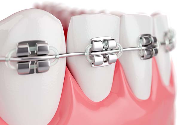 Metal Braces (Partial/Full)