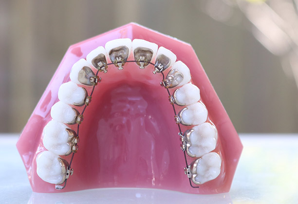 Lingual Braces