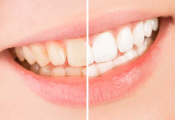 In-Office Teeth Whitening