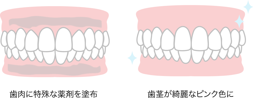 Gum Bleaching