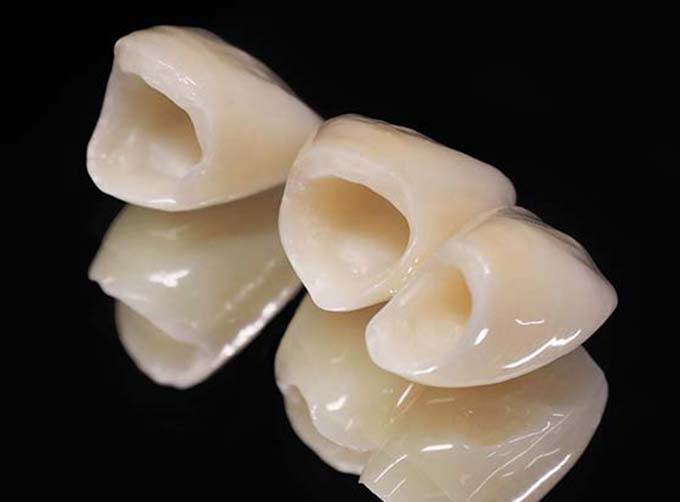 Ceramic Crowns (Overlays)