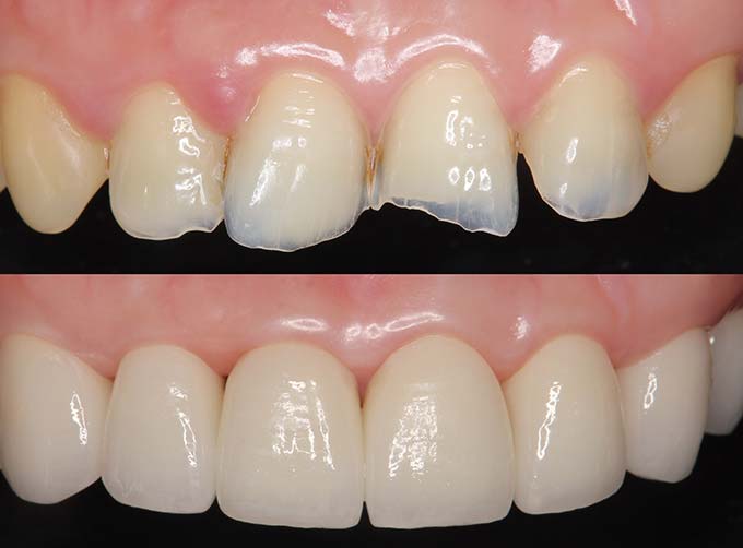 Ceramic Crowns (Overlays)