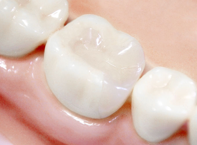 Inlays (Fillings)