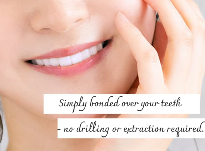 Laminate Veneers