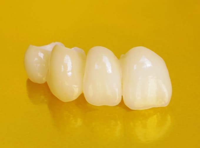 Ceramic Crowns