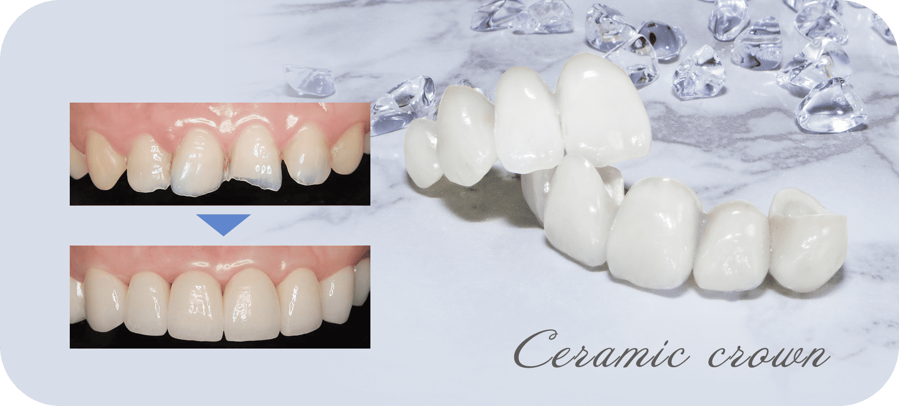 Ceramic Crowns (Caps)