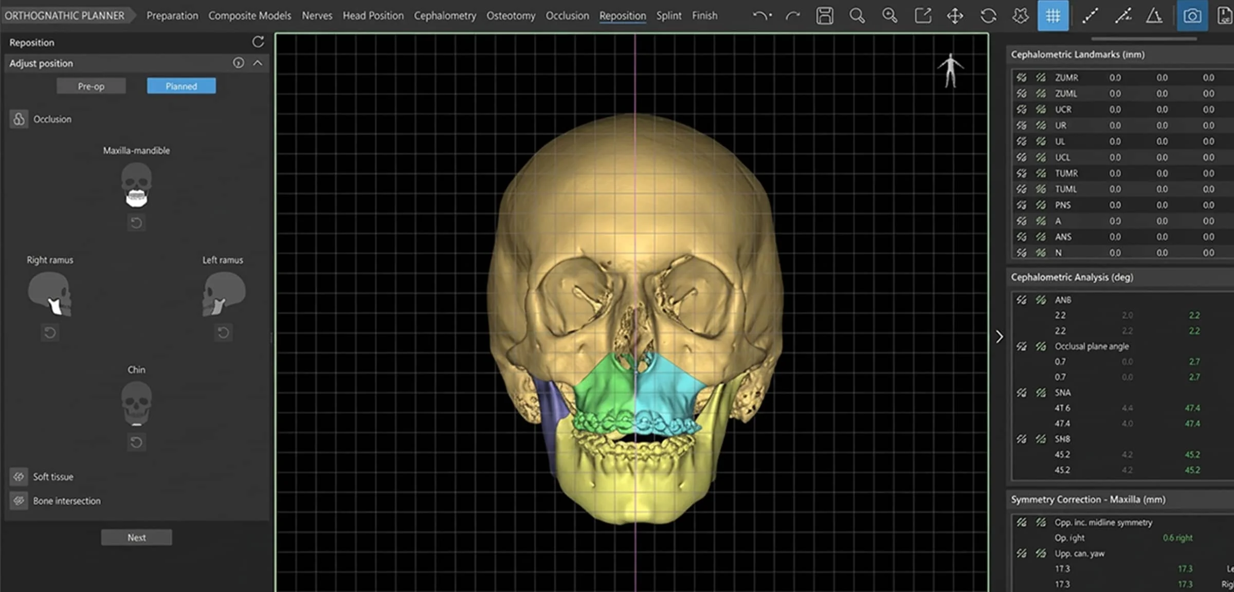 東京で骨切りなら「東京銀座A CLINIC デンタル」”3Dシミュレーションソフト”