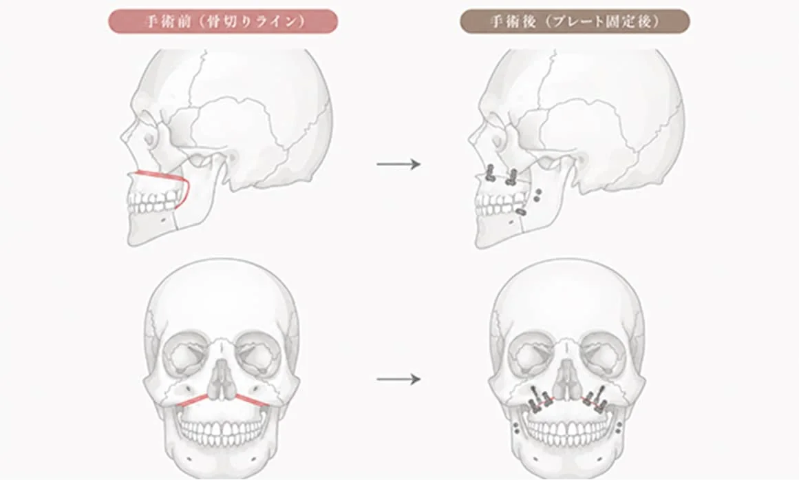 東京で骨切りなら「東京銀座A CLINIC デンタル」”ルフォーI型骨切り術”
