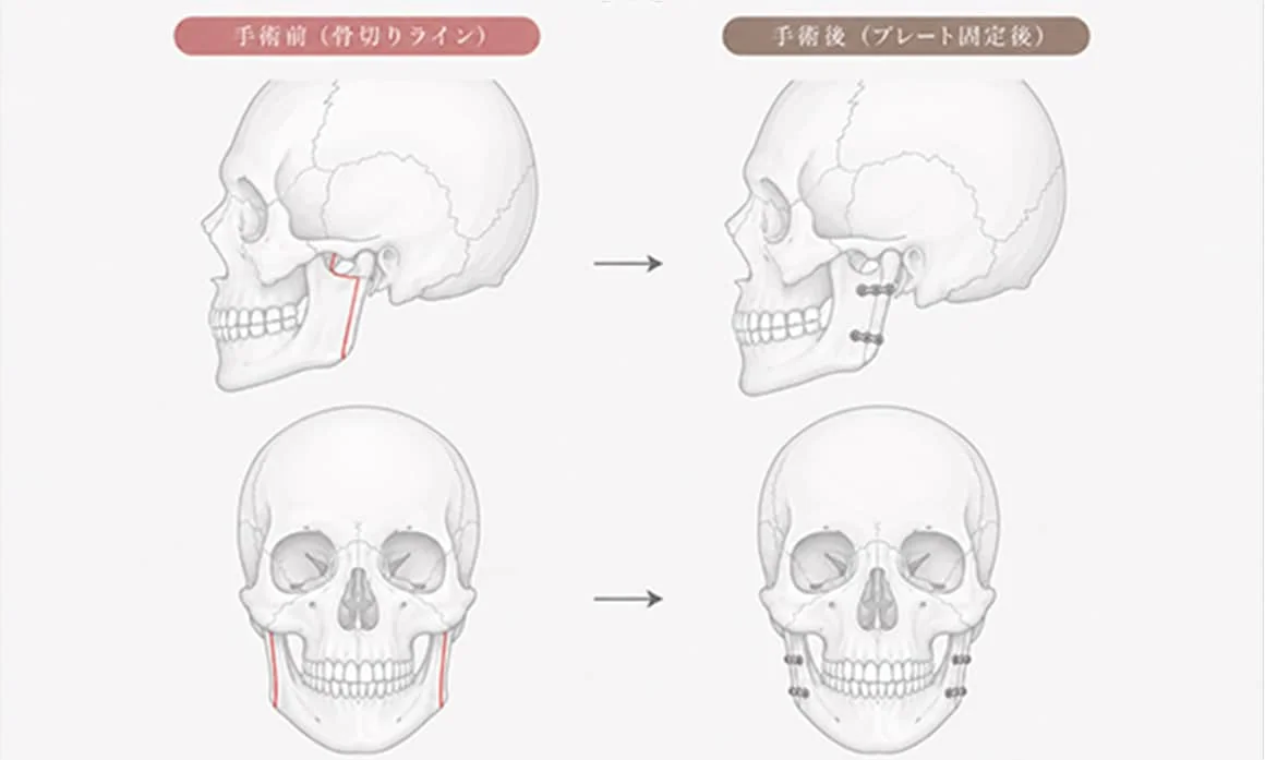 東京で骨切りなら「東京銀座A CLINIC デンタル」”SSRO（下顎枝矢状分割術）”