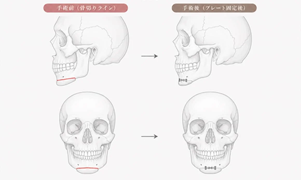 東京で骨切りなら「東京銀座A CLINIC デンタル」”オトガイ形成術”