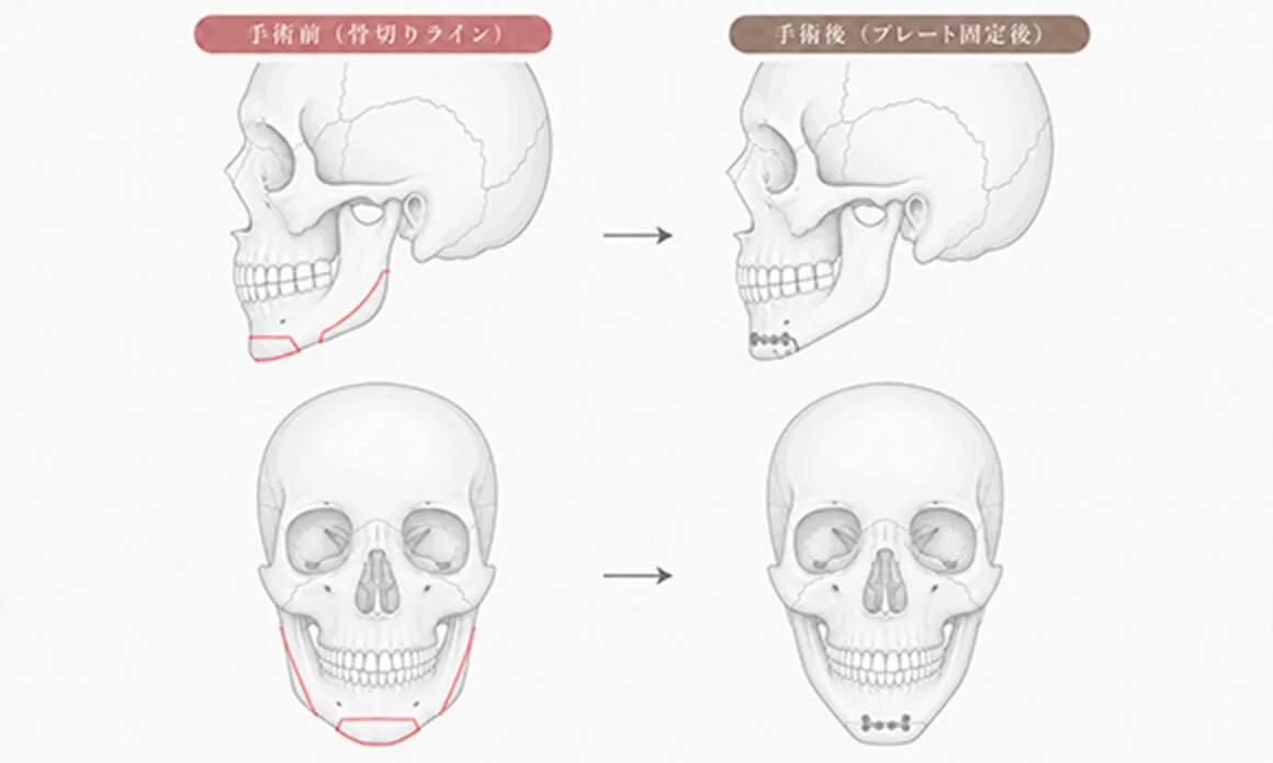 東京で骨切りなら「東京銀座A CLINIC デンタル」”Vライン形成術”