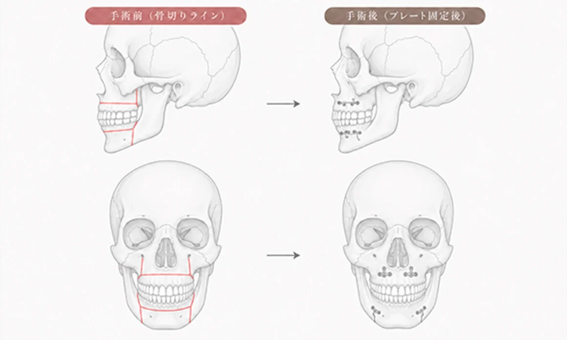 東京で骨切りなら「東京銀座A CLINIC デンタル」”セットバック（分割骨切り術ASO）”