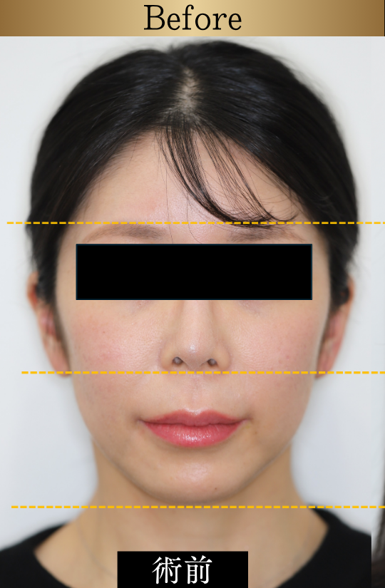 東京で骨切りなら「東京銀座A CLINIC デンタル」”画像の内容”