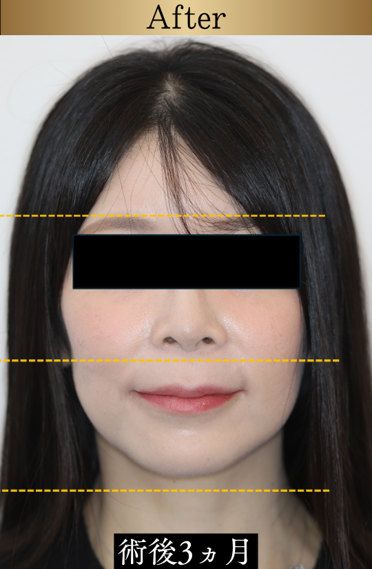 東京で骨切りなら「東京銀座A CLINIC デンタル」”画像の内容”