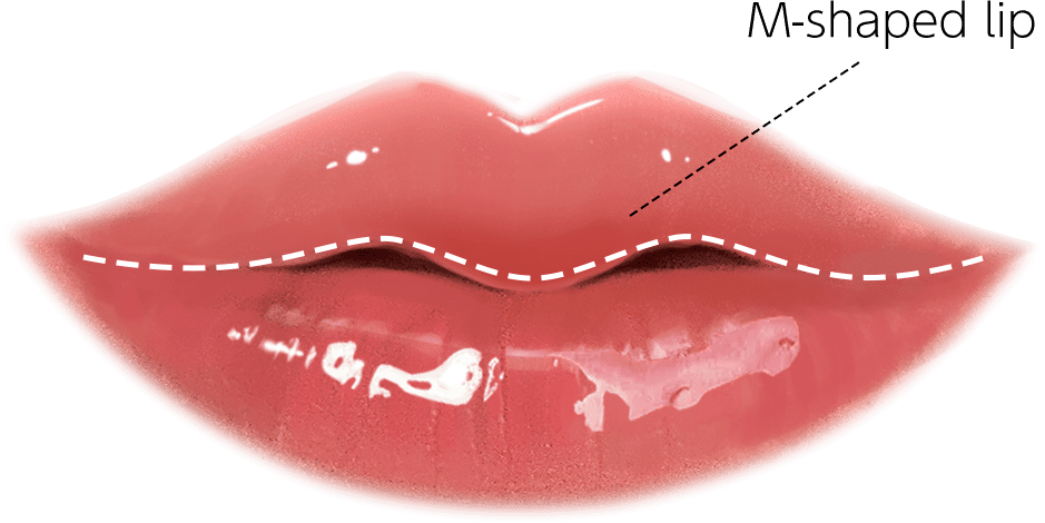 M字リップ