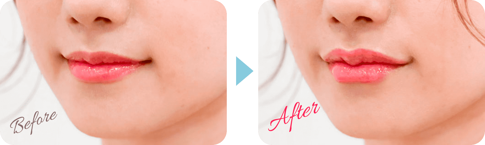 スマイルリップ症例