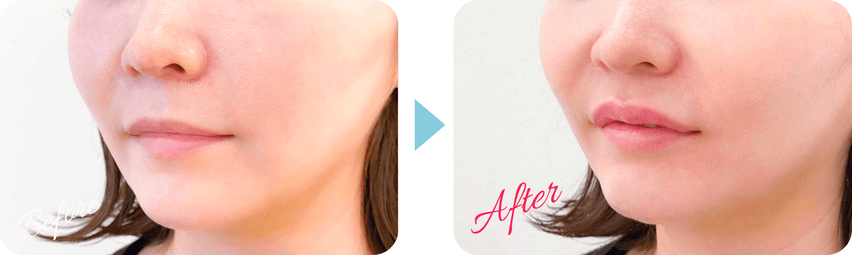 スマイルリップ症例