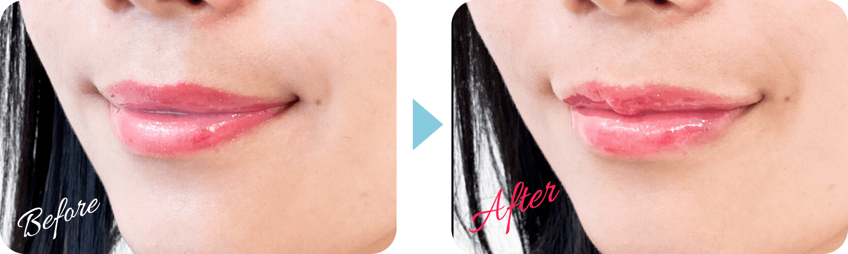 スマイルリップ症例