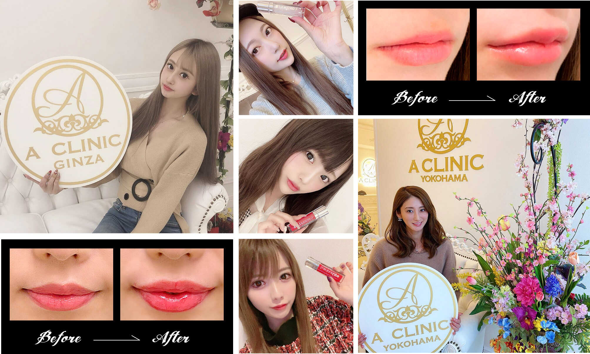 スマイルリップを受けたインスタグラマー