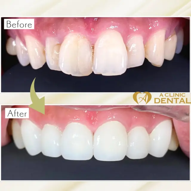 A CLINIC DENTALのジルコニアセラミッククラウンで、白く美しい歯を手に入れませんか？🦷💎

🔍ジルコニアセラミッククラウンとは？
・ジルコニアのフレームに高品質セラミックを焼き付けたクラウン（被せ物）
・天然歯に近い透過性とツヤ感で、光を受けても自然に見える
・強度に優れ、耐久性もバツグン！硬いものを噛んでも安心

⏱️治療の流れ（※症例により前後します）
１　カウンセリング＆口腔内スキャン（最先端デジタル技術で痛みゼロ）
２　仮歯装着＆色合わせ
３　ジルコニアフレームの試適
４　最終セット

※2～3回のご来院で完成が可能です

🌟こんな方におすすめ
• 前歯の色ムラや変色が気になる
• 今ある銀歯を自然な白い歯に替えたい
• 強度が高く、長持ちする素材を選びたい
• 金属アレルギーや歯茎の黒ずみが心配

💎A CLINIC DENTALのこだわりポイント
• 完全デジタル設計：3Dプリンターとミリングマシンで精密フィット
• オールセラミック仕上げ：変色・着色に強く、美しさを長期間キープ
• 完全個室＆プライバシー保護：周りを気にせずリラックスして施術
•経験豊富な医師による丁寧な最終チェック

📲今すぐ無料カウンセリングのご予約をどうぞ！
LINEまたは公式サイトで「デンタル院のInstagramを見た」とお伝えいただくと、2万円OFFの特典がございます🎁

━━━━━━━━━━━━━━━━━━━━
📍東京都中央区銀座5-13-19 デュープレックス銀座タワー12F
⏰10:00〜19:00（水曜・不定休／年末年始を除く）
☎︎03-6264-3086
LINE▶︎ @aclinic_dental
━━━━━━━━━━━━━━━━━━━━

#A_CLINIC_DENTAL #ジルコニアセラミッククラウン #審美歯科 #銀座 #白い歯 #デジタル歯科 #完全個室 #美歯 #無料カウンセリング #笑顔自信に