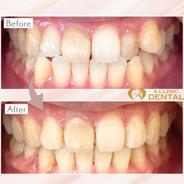 ✨透明だから目立たない、キレイを我慢しない✨

「歯並びを整えたいけど、ワイヤーはイヤ…」

そんなあなたにおすすめなのが、A CLINIC DENTALのマウスピース矯正（インビザライン）。
透明のアライナーを1日20時間以上装着するだけで、周りに気づかれずに美しい歯並びへと導きます👄✨

⏳治療期間は症例によって異なりますが、部分矯正なら最短数ヶ月、全体矯正でも1年半～2年ほどで終了するケースが多数。
ライフスタイルに合わせてプランをご提案します📅💡

🦷デジタルプランニング×定期的なアライナー交換で、痛みや違和感を最小限に。さらに、通院時の調整料は何度でも無料だから、経済的にも安心です。

💎こんな方におすすめ
・人前に出るお仕事で矯正装置を見せたくない
・短期間でできるだけ歯並びを整えたい
・普段のケアはいつも通りにしたい

👩‍⚕️経験豊富な歯科医師が、お口元の美と機能をトータルでサポート。

完全予約制＆銀座駅すぐの好立地で、忙しいあなたも無理なく通えます。

📲まずはLINEまたは公式サイトから無料カウンセリング予約を！
「デンタル院のInstagramを見た」とお伝えいただくと、2万円OFFキャンペーンも適用可能です💝

━━━━━━━━━━━━━━━━━━━━
📍東京都中央区銀座5-13-19 デュープレックス銀座タワー12F
⏰10:00〜19:00（水曜・不定休／年末年始を除く）
☎︎03-6264-3086
LINE▶︎ @aclinic_dental
━━━━━━━━━━━━━━━━━━━━

#A_CLINIC_DENTAL #マウスピース矯正 #インビザライン #銀座 #歯並び改善 #透明矯正 #笑顔に自信 #デジタル矯正 #無料カウンセリング