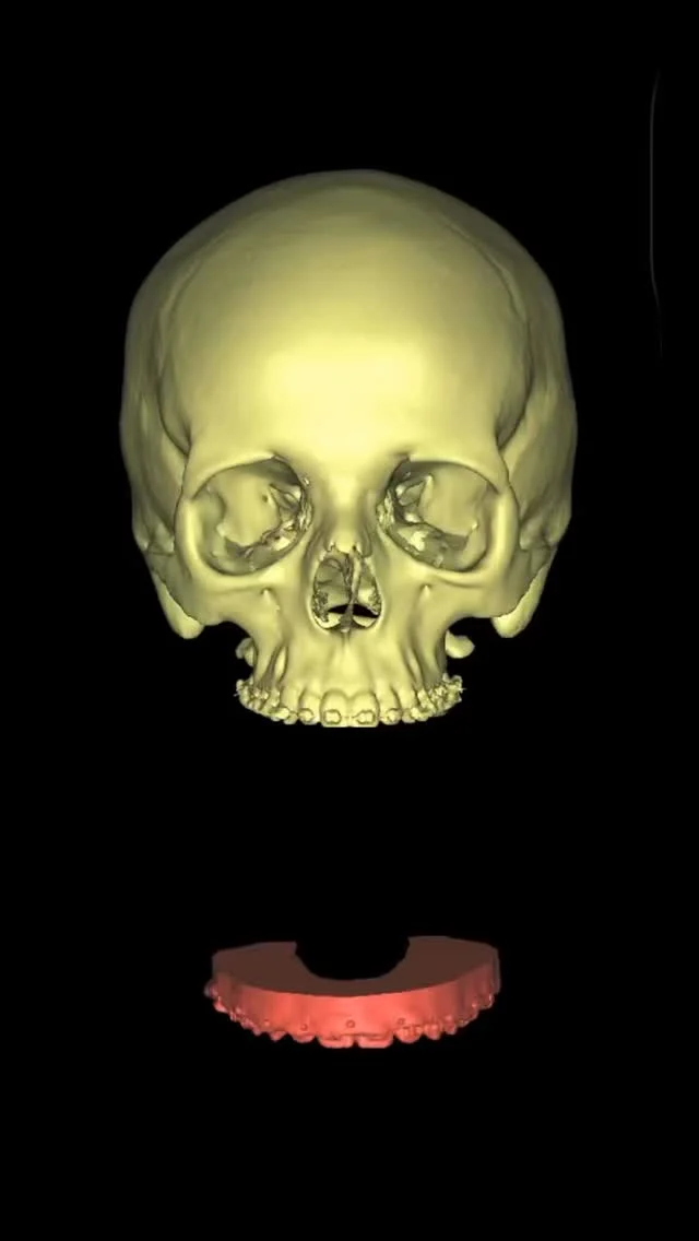 CTでは歯の細部まで写すことはできません。
歯には複雑な溝、山や谷が存在しており、その細部はCTでは確認できません。
では、噛み合わせが最重要と考えられる「骨切り」を精度高く行うためにはどうれば良いでしょうか。

それは歯型を光学スキャナーで精度良く取り込み、それをCTに合体させれば良いのです。
そうすることで、噛み合わせの細部までシミュレーションソフト上で再現できる、ミリ単位の予測実現性の高い骨切りを行うことができます。
当院では、さらにマウスピース矯正を用いて、歯の動きをシミュレーションして、手術時期の決定や術前の矯正を検討しています。もちろん、手術を先に行うサージェリーファースト法も同様の方法で行うことができます。

結論：
見た目だけでなく、噛み合わせ・顎関節・表情筋のバランスを取り戻すことで、自然で調和のとれた顔貌へ導きます。

デジタル技術を駆使した、次世代の骨切りであなたの口元の美の追求をお手伝いさせてください。

【骨切り（顎矯正手術）　無料カウンセリング】
無料カウンセリングではCT・パノラマX線写真撮影、口腔内写真撮影、顔貌写真撮影をさせていただき、的確な診査診断のもと、ご本人の理想に近づける治療方針を一緒に練っていければと思います。
ご予約はプロフリンクより。

半年間のキャンペーンですがモニター募集をしているため、骨切りが50%オフの料金となっています。モニターが集まり次第、終了とさせていただきます。

#骨切り #両顎手術 #顎変形症　#口腔外科専門医 #小顔