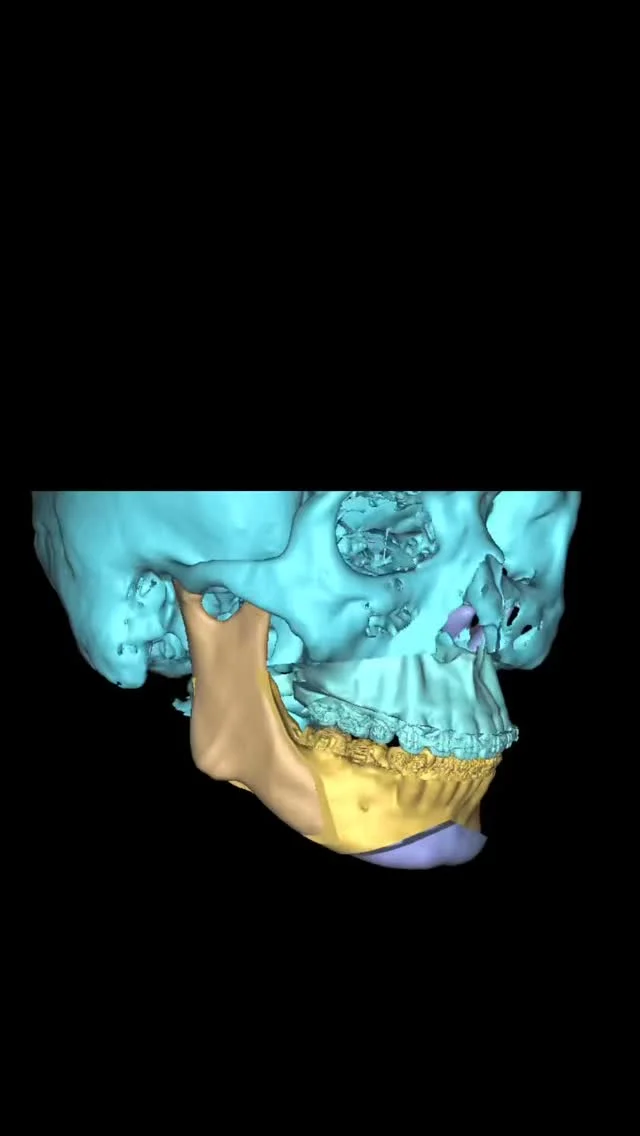 歯型を光学スキャナーで精度良く取り込み、それをCTに合体させた複合体を用いてシミュレーションします！

そうすることで、噛み合わせの細部までシミュレーションソフト上で再現できる、ミリ単位の予測実現性の高い骨切りを行うことができます。
当院では、さらにマウスピース矯正を用いて、歯の動きをシミュレーションして、手術時期の決定や術前の矯正を検討しています。もちろん、手術を先に行うサージェリーファースト法も同様の方法で行うことができます。

見た目だけでなく、噛み合わせ・顎関節・表情筋のバランスを取り戻すことで、自然で調和のとれた顔貌へ導きます。

デジタル技術を駆使した、次世代の骨切りであなたの口元の美の追求をお手伝いさせてください。

【骨切り（顎矯正手術）　無料カウンセリング】
無料カウンセリングではCT・パノラマX線写真撮影、口腔内写真撮影、顔貌写真撮影をさせていただき、的確な診査診断のもと、ご本人の理想に近づける治療方針を一緒に練っていければと思います。
ご予約はプロフリンクより。

半年間のキャンペーンですがモニター募集をしているため、骨切りが50%オフの料金となっています。モニターが集まり次第、終了とさせていただきます。

#骨切り #両顎手術 #顎変形症　#口腔外科専門医 #小顔