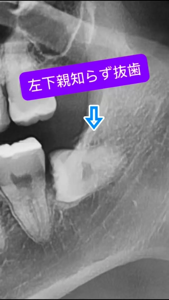 左下埋伏親知らず抜歯。レベルⅡBの水平埋伏。

歯冠の除去に少し、手間取りましたが、その後はスムーズに。

なんでもお手のもの😊
短時間で安全かつ痛くなく、完遂できます。

#親知らず抜歯 #口腔外科　#口腔外科専門医 #痛くない抜歯 #東京口腔外科