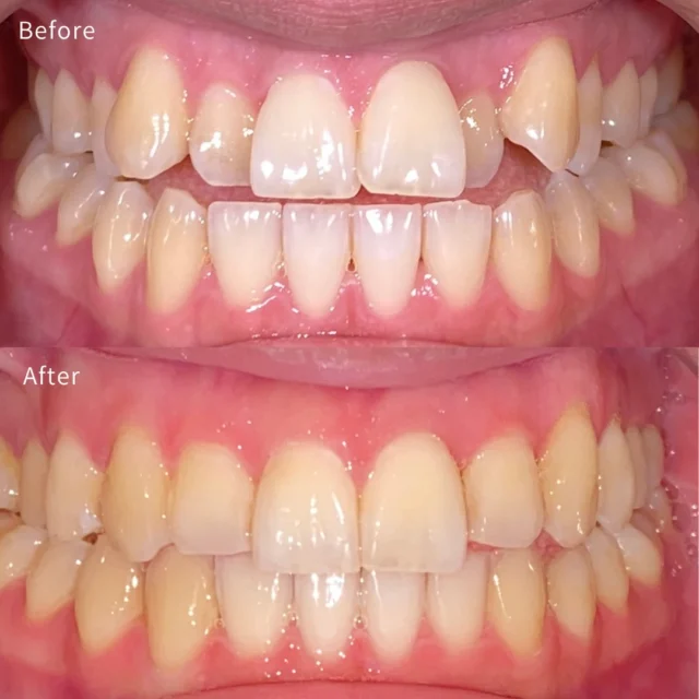 🦷【この状態でも、インビザラインでここまで整います】

前歯のガタつきだけでなく ✔ 開咬傾向 ✔ 3級傾向 ✔ 前歯の舌側転位
見た目以上にコントロールが必要な症例でした

インビザラインで ✔ 歯の位置と角度を細かく調整しながら 👉 全体のバランスを設計
結果として 👉 自然で整った歯並びに仕上げています

マウスピース矯正は 「簡単な症例だけ」ではありません
👉 どこまで設計できるかで結果は変わります

インビザラインでも対応可能です
気になる方はご相談ください