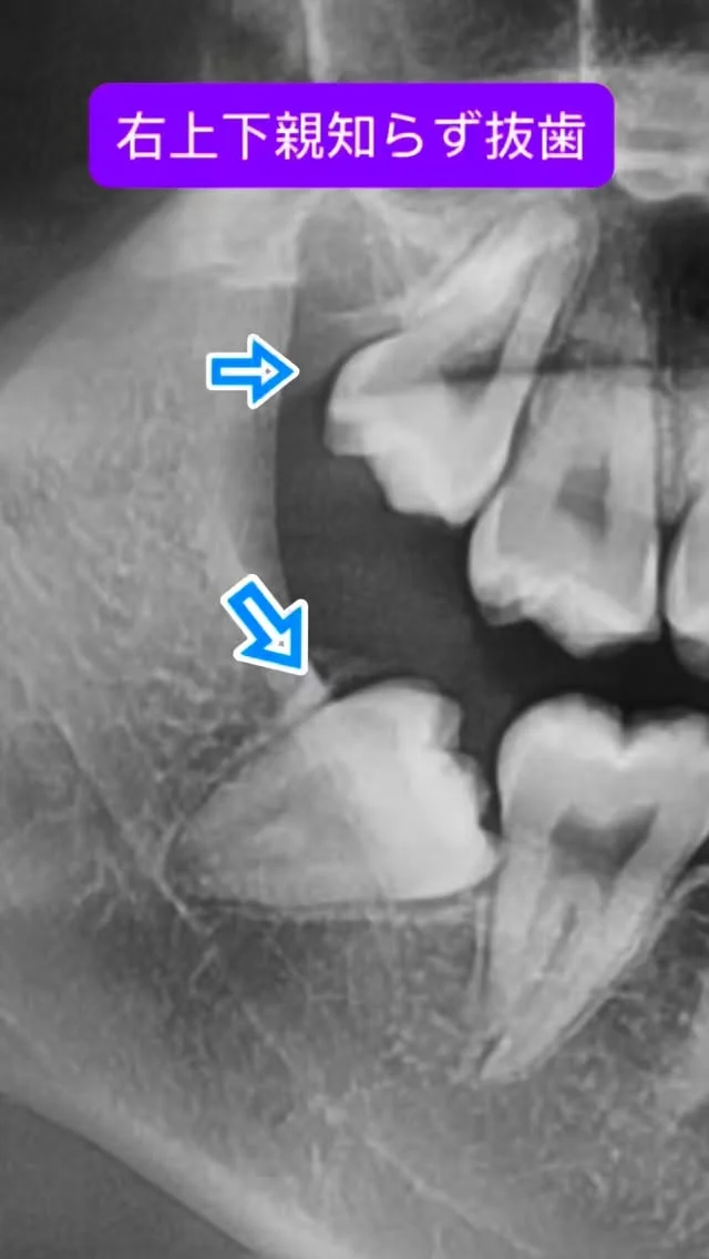 比較的ライトな右上下親知らず抜歯🩲🦷

ちょい斜めですが、そこはいつもどーり上手に分割🧱

もしかしたら最速？🏍️😊

ま、なんでもお手のもの😊

短時間で安全かつ痛くなく、完遂できます。

#親知らず抜歯 #口腔外科　#口腔外科専門医 #痛くない抜歯 #東京口腔外科 抜歯動画 親知らず神銀座口腔外科