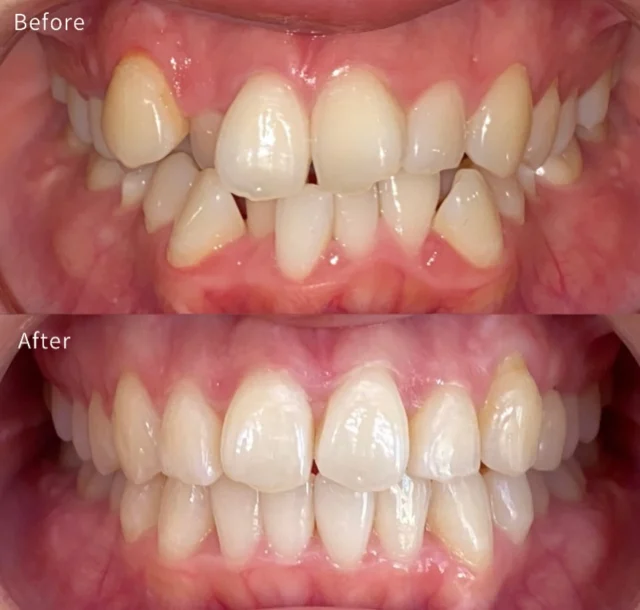 🦷【抜歯なしでも、ここまで整います】

「歯を抜かないと無理ですか？」 とよく聞かれますが
→ 条件が合えば、抜歯せずに改善できるケースもあります

ただし ◽ スペースの確保 ◽ 歯の動かし方 ◽ 噛み合わせの設計

ここを間違えると ⚠️ 前歯が出る ⚠️ 噛み合わせが不安定になる

今回の症例は ◎ 抜歯せずにバランスを崩さず改善

矯正は 「抜く・抜かない」ではなく → どう設計するかがすべてです
マウスピース矯正は当院へ