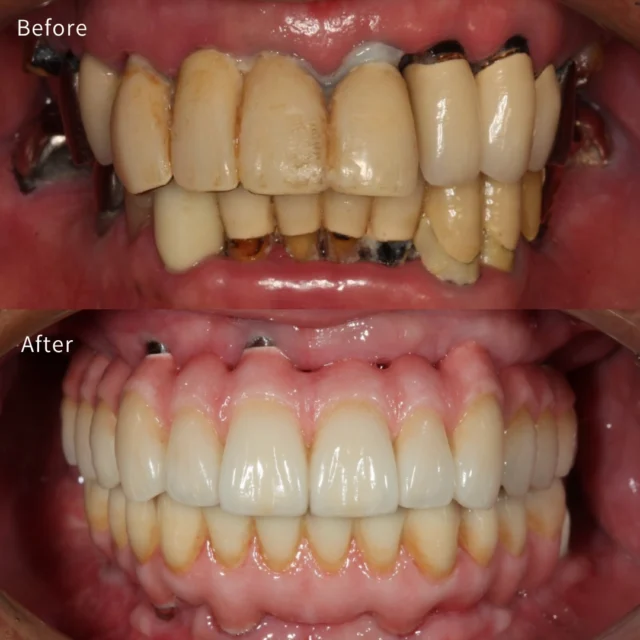🦷【どんなお口元でも、再建は可能です】

歯が抜けている 😣 噛めない 😷 見た目が気になる 😔 どこに相談していいか分からない
そんな状態で来院される方は少なくありません。

今回の症例は、失われた歯を全体的に見直し、 ✨ 全顎的にインプラント治療を行ったケースです。

インプラントは ただ「歯を入れる治療」ではありません。
✔ 噛み合わせ ✔ 見た目 ✔ 清掃性 ✔ 長期安定性

これらを設計してこそ、 本当の意味で機能する治療になります。

📍本数が多いケースほど、 1本単位ではなく お口全体の設計力 が重要です。

「もう無理かもしれない…」 そう思っている方ほど、一度ご相談ください。

 A CLINIC デンタル 銀座で、審美と機能を両立する治療を。