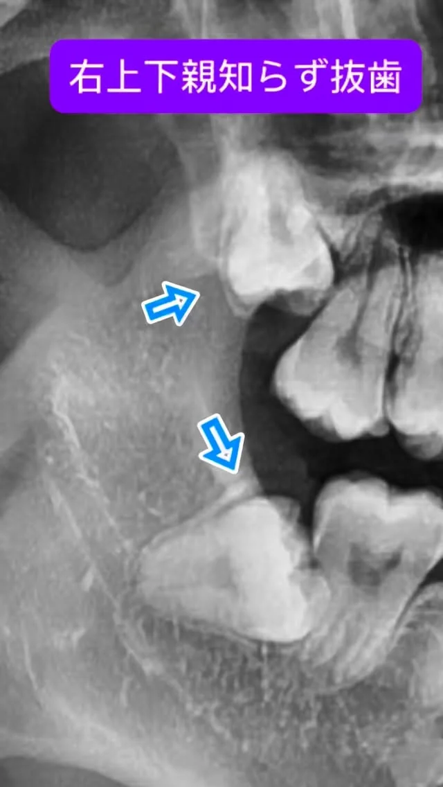 右上下親知らず抜歯。
上は歯の頭1個分高い位置。
下は頭食い込み系の埋伏。

数倍速ですが、こんな雰囲気で抜歯をします。

ま、なんでもお手のもの😊

短時間で安全かつ痛くなく、完遂できます。

#親知らず抜歯 #口腔外科　#口腔外科専門医 #痛くない抜歯 #親知らず神