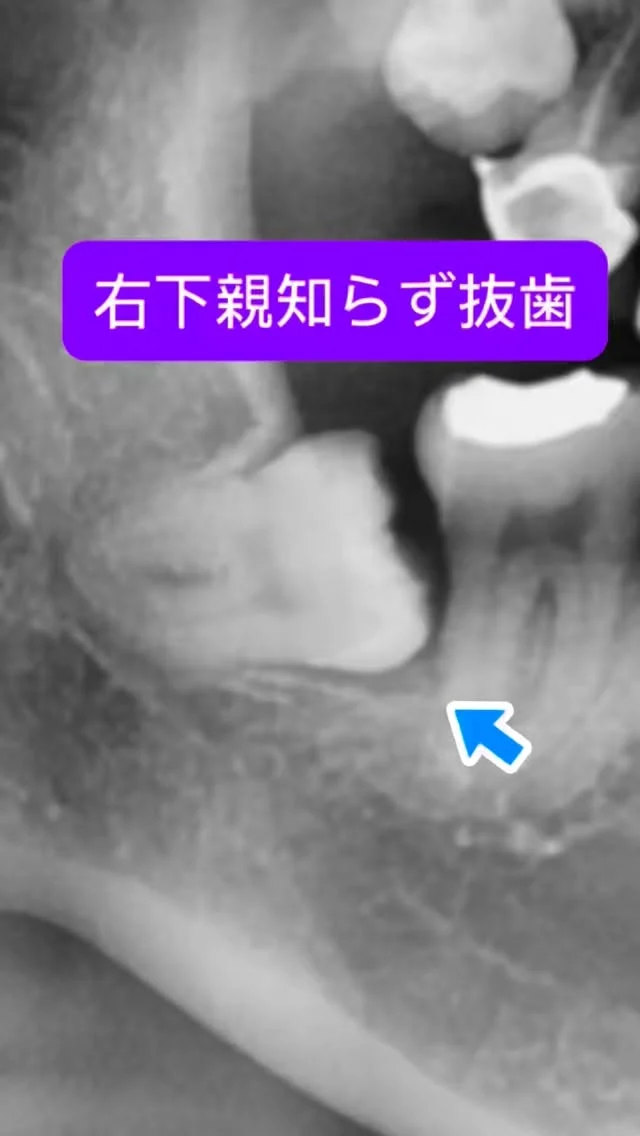 右下水平埋伏親知らず抜歯。レベルI Bの水平埋伏。

歯冠の除去に少し、手間取りましたが、その後はスムーズに。

なんでもお手のもの😊
短時間で安全かつ痛くなく、完遂できます。

#親知らず抜歯 #口腔外科　#口腔外科専門医 #痛くない抜歯 #東京口腔外科