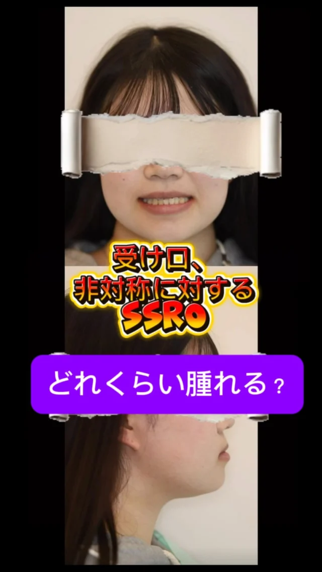 受け口や非対称に用いられるSSRO
これは下あごを動かして噛み合わせと横顔を整える手術。口の外に傷を残さず、機能と見た目の両方を改善します。

ダウンタイムは約10日
詳細を知りたい人は無料カウンセリングへ😊

【骨切り（顎矯正手術）　無料カウンセリング】
無料カウンセリングではCT・パノラマX線写真撮影、口腔内写真撮影、顔貌写真撮影をさせていただき、的確な診査診断のもと、ご本人の理想に近づける治療方針を一緒に練っていければと思います。お気軽にお越しください。

予約はプロフリンクからできます。

あなたの口元の美の追求をお手伝いさせてください。

#骨切り #両顎手術 #下顎前突 #受け口 #ダウンタイム