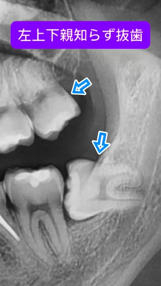 左上下親知らず抜歯🦷

上は簡単、下は根っこが2本に広く分かれてしっかりタイプ🦷
適切に歯根分割すれば1つ1つ抜けてくる。
ま、なんでもお手のもの😊

短時間で安全かつ痛くなく、完遂できます。

#親知らず抜歯 #口腔外科　#口腔外科専門医 #痛くない抜歯 #東京口腔外科