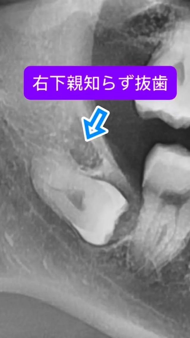 難易度高めの右下親知らず抜歯🦷

骨を削っても削っても全貌は見えず🤭
引っかかる頭を丁寧に分割して、抜去します。
少し時間かかってしまいました🙇‍♂️

意気込みすぎたかな。

ま、なんでも抜けますので😊

（比較的）短時間で安全かつ痛くなく、完遂できます。

#親知らず抜歯 #口腔外科　#口腔外科専門医 #痛くない抜歯 #東京口腔外科