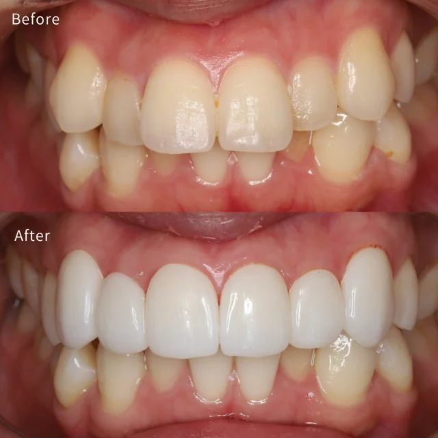 🦷【セラミック矯正は“悪”なのか？】

最近よく見ますよね 「セラミック矯正＝危険」という投稿⚠️

結論から言うと 👉 適応を間違えれば、確かに問題になります 👉 ただし、患者さんの要望によっては選択肢の一つです

今回のケースは

✔ とにかく短期間で改善したい ✔ 矯正は受け入れられない ✔ 自分の歯より白くしたい
という明確な希望がありました

つまり  「時間」と「方法」に強い制約があるケースです⏱️

本来の第一選択は
・矯正で歯列を整える ・ホワイトニングで色調改善

これが最も歯を守るアプローチです🛡️

ただし今回は 👉 患者側がそのルートを選択しない
この時に重要なのは「やらない」か「代替案を設計する」か

今回は
✔ 前突感のコントロール ✔ 形態・色調の最適化
を前提にセラミックで設計しています🧩

（写真では分かりにくいですが 口元の突出感は改善しています）

ここで誤解してほしくないのは
セラミック矯正は第一選択ではない
ただし、すべて否定するものでもない
ということ

重要なのは
「何をやるか」ではなく  「どう設計するか」
そして  「その選択を誰が、なぜ決めたのか」

審美治療は 単なる見た目の改善ではなく
人生の優先順位に対する医療介入です

だからこそ 複数の選択肢を提示した上で設計する
それが医療側の役割だと考えています

審美も、機能も、長期も すべてを踏まえて設計したい方はご相談ください🦷