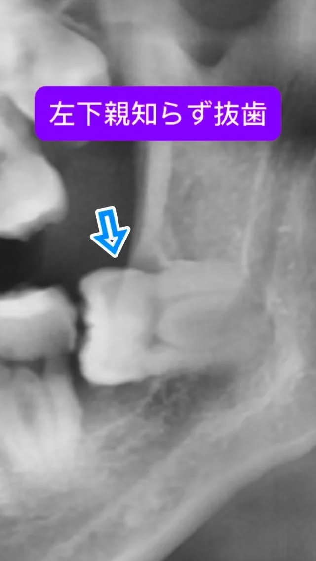 左下埋伏親知らず抜歯。根っこゴツめで、神経激チカ症例。
こーゆーのが難易度が高い例です🦷

数倍速ですが、こんな雰囲気で抜歯をします。

なんでもお手のもの😊

短時間で安全かつ痛くなく、完遂できます。

#親知らず抜歯 #口腔外科　#口腔外科専門医 #痛くない抜歯 #東京口腔外科