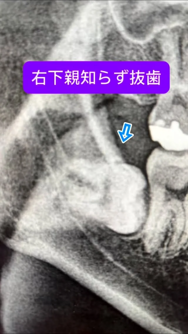 右下埋伏親知らず抜歯。レベルⅡBの水平埋伏。

なんでもお手のもの😊
短時間で安全かつ痛くなく、完遂できます。

#親知らず抜歯 #口腔外科　#口腔外科専門医 #痛くない抜歯 #東京口腔外科
