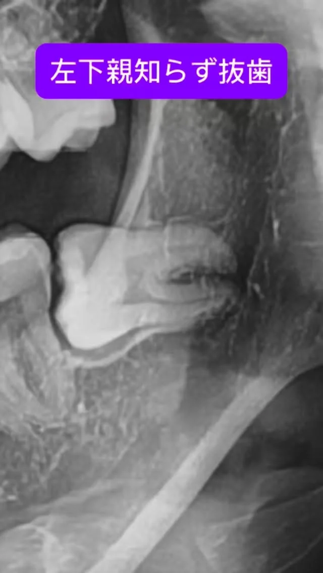 臨場感のある内容を🦷
Level ⅡAの左下親知らず抜歯。
歯根は比較的しっかりめ。

ポイントをかいつまんで、こんな雰囲気で抜歯をします。

なんでもお手のもの😊

短時間で安全かつ痛くなく、完遂できます。

#親知らず抜歯 #口腔外科　#口腔外科専門医 #痛くない抜歯 #東京口腔外科