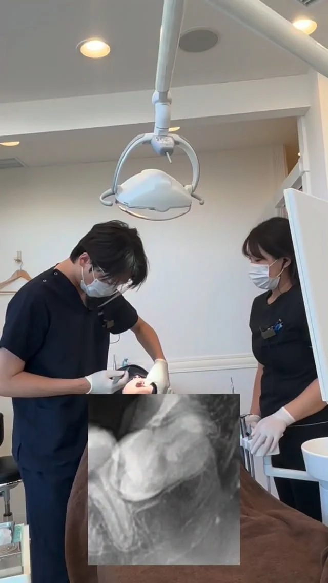臨場感のある内容を🦷
左下親知らず抜歯。

ポイントをかいつまんで、こんな雰囲気で抜歯をします。

なんでもお手のもの😊

短時間で安全かつ痛くなく、完遂できます。

#親知らず抜歯 #口腔外科　#口腔外科専門医 #痛くない抜歯 #東京口腔外科