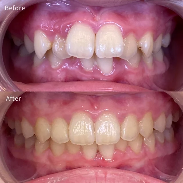 🦷 マウスピース矯正症例

「ワイヤー矯正は見た目が気になるし、虫歯になりやすいと聞いたので、できればマウスピースで治したい」
そんなご希望で来院された患者様です。

確かに歯並びの重なりはありましたが、このケースはマウスピース矯正の適応でした。
治療後は前歯のガタつきが改善し、歯列全体も自然に整いました✨

見た目がきれいになっただけでなく、
✔️ 歯磨きがしやすくなる ✔️ 汚れが溜まりにくくなる ✔️ 将来的な虫歯や歯周病のリスクを減らせる
というメリットもあります。

マウスピース矯正は取り外しができるため、食事や歯磨きが普段通り行えるのも大きな特徴です😊
もちろん全ての症例がマウスピースだけで治せるわけではありません。
しかし近年は治療技術の進歩により、多くの症例でマウスピース矯正が可能になっています。

大切なのは 「マウスピースかワイヤーか」ではなく、
その方のお口の状態に合わせて適切に診断し、治療計画を立てることです🦷
歯並びで悩んでいる方は、一度ご相談ください✨