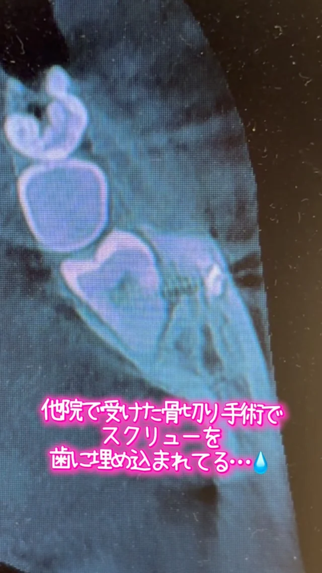他院で受けた骨切りの際に行ったネジ止めが、親知らずを串刺し状態に😰🦷
そのため、神経が死んでしまい、壊死した組織が根尖に病気を作ってます。
抜かないわけにいかない…ただ、ネジ取らなきゃ抜けない…

静脈内鎮静で除去、抜糸を行います。ネジ止めは皮膚を貫通させて止めているため、口の中からネジを取るのは至難の業…。大変💧

ただ、親知らず神なら短時間で安全かつ痛くなく、完遂できます。

最後に…
骨切り考えてる人は気をつけて…🪛

#親知らず抜歯 #口腔外科　#口腔外科専門医 #痛くない抜歯 #東京口腔外科