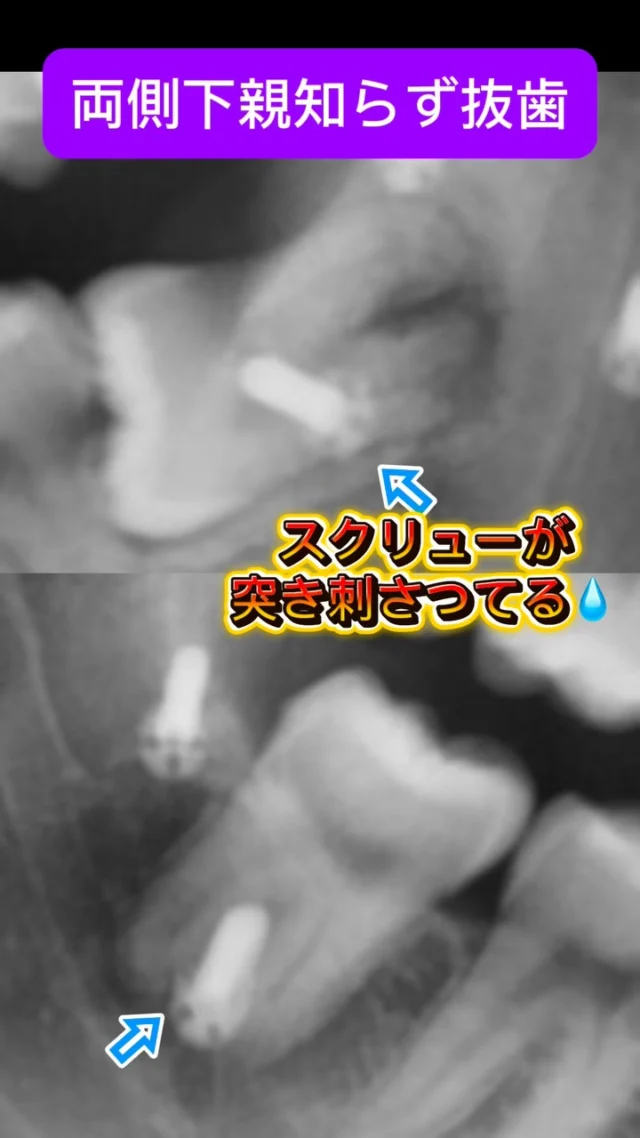 他院で受けた骨切りの際に行ったネジ止めが、親知らずを串刺し状態に😰🦷
そのため、神経が死んでしまい、壊死した組織が根尖に病気を作ってます。
抜かないわけにいかない…ただ、ネジ取らなきゃ抜けない…

静脈内鎮静で除去、抜糸を行います。ネジ止めは皮膚を貫通させて止めているため、口の中からネジを取るのは至難の業…。大変💧

ただ、親知らず神なら短時間で安全かつ痛くなく、完遂できます。

最後に…
骨切り考えてる人は気をつけて…🪛

#親知らず抜歯 #口腔外科　#口腔外科専門医 #痛くない抜歯 #東京口腔外科