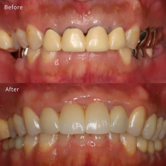 🦷 前歯だけではなく、奥歯まで。 見た目だけではなく、機能まで。

この患者様は、
・前歯の見た目が気になる ・歯が抜けたままになっている部分がある ・歯ぐきが見えやすい（ガミースマイル） ・噛み合わせにも問題がある
という複数の悩みを抱えていました。

そこで当院では、
✅ 部分矯正 ✅ ガミースマイル改善 ✅ 前歯のセラミック治療 ✅ 奥歯のインプラント治療
を組み合わせ、包括的な治療を行いました。

審美治療というと前歯ばかりに目が行きがちですが、実際には奥歯でしっかり噛める環境がなければ、前歯への負担が増え、長期的な安定は得られません。
また、セラミックだけを綺麗に入れても、歯肉ラインや歯並びが整っていなければ自然な仕上がりにはなりません。

だからこそ、
✨ 歯並び ✨ 歯ぐき ✨ 前歯の形態 ✨ 奥歯の咬合支持
をトータルで整えることが重要です。

治療後は口元の印象が自然になっただけでなく、しっかり噛める環境も回復することができました。
当院ではその場だけ綺麗にするのではなく、
「10年後も機能し、美しくあり続けること」
を目標に治療計画を立てています。

━━━━━━━━━━━━━━━
👨‍⚕️ A CLINIC デンタル 院長　菅野友太郎
美しさも、機能も、長期で守る歯科医療。