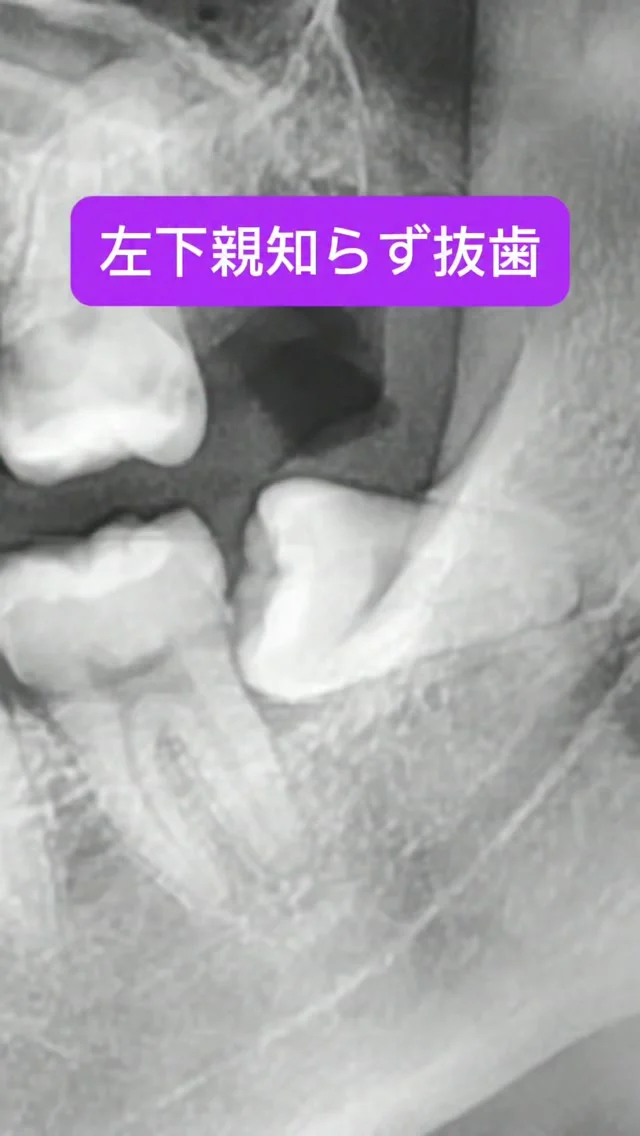 左下親知らず抜歯🦷
水平埋伏親知らず抜歯の中では最も簡単な部類とも言えます。
基本に忠実に行えば2〜3分で終えられるものばかりです。

なんでもお手のもの😊

短時間で安全かつ痛くなく、完遂できます。

親知らず抜歯 口腔外科　口腔外科専門医 痛くない抜歯 東京口腔外科